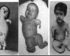 Thalidomide: The deformed children of an “innocent” pill